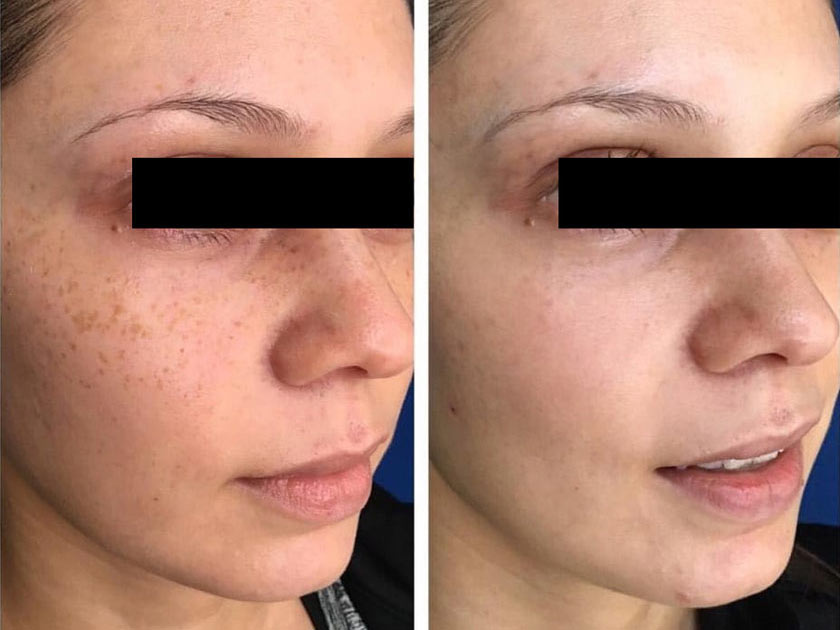 before-after-1