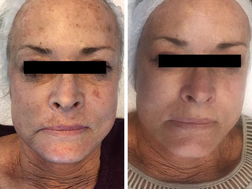 before-after-2